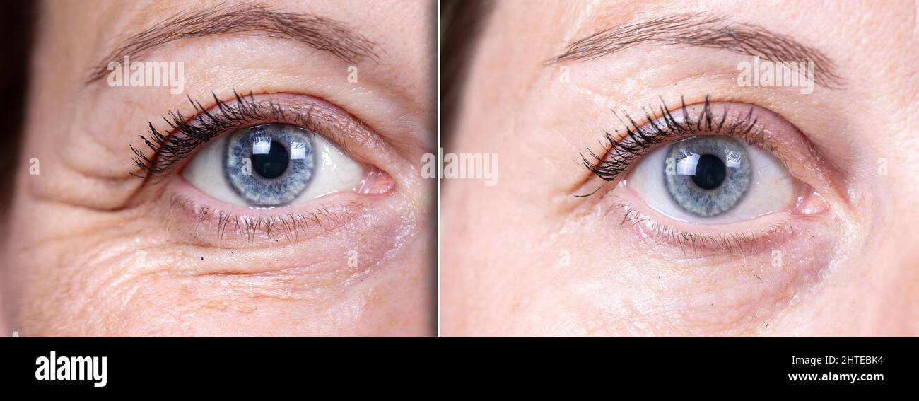 Woman eyes before and after wrinkles treatment to remove crow's feet