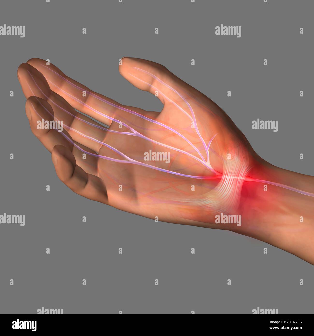Carpal tunnel syndrome, illustration Stock Photo Alamy
