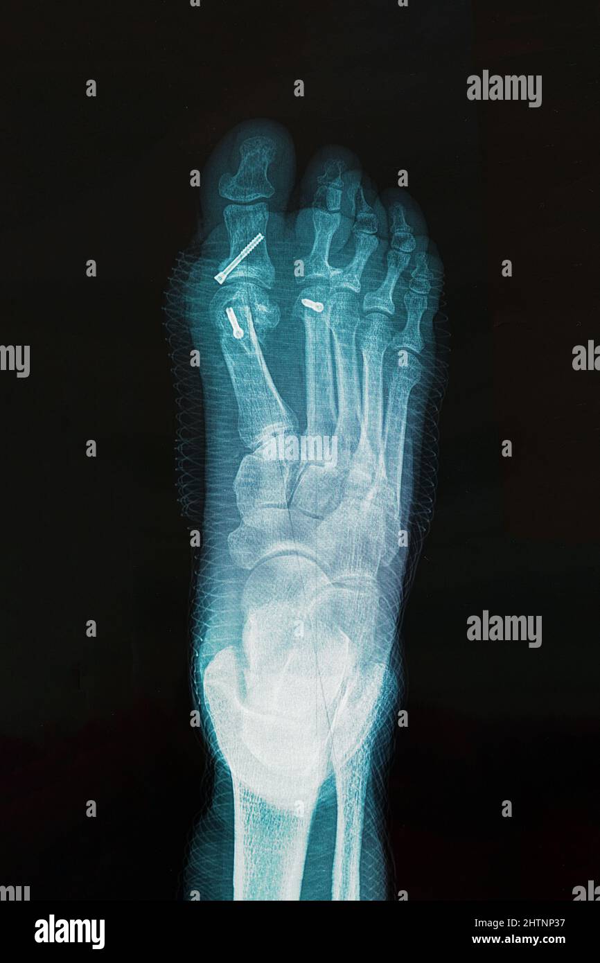 X-ray of foot after surgery to correct Hallux varus condition ...