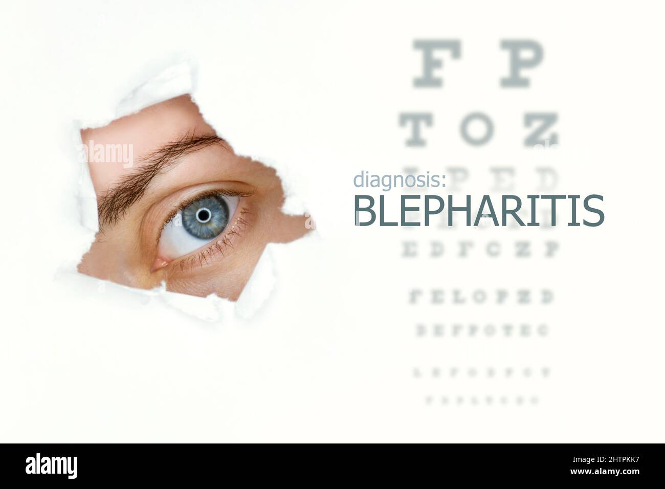 Blepharitis disease poster with eye test and blue eye on left. Isolated on white Stock Photo