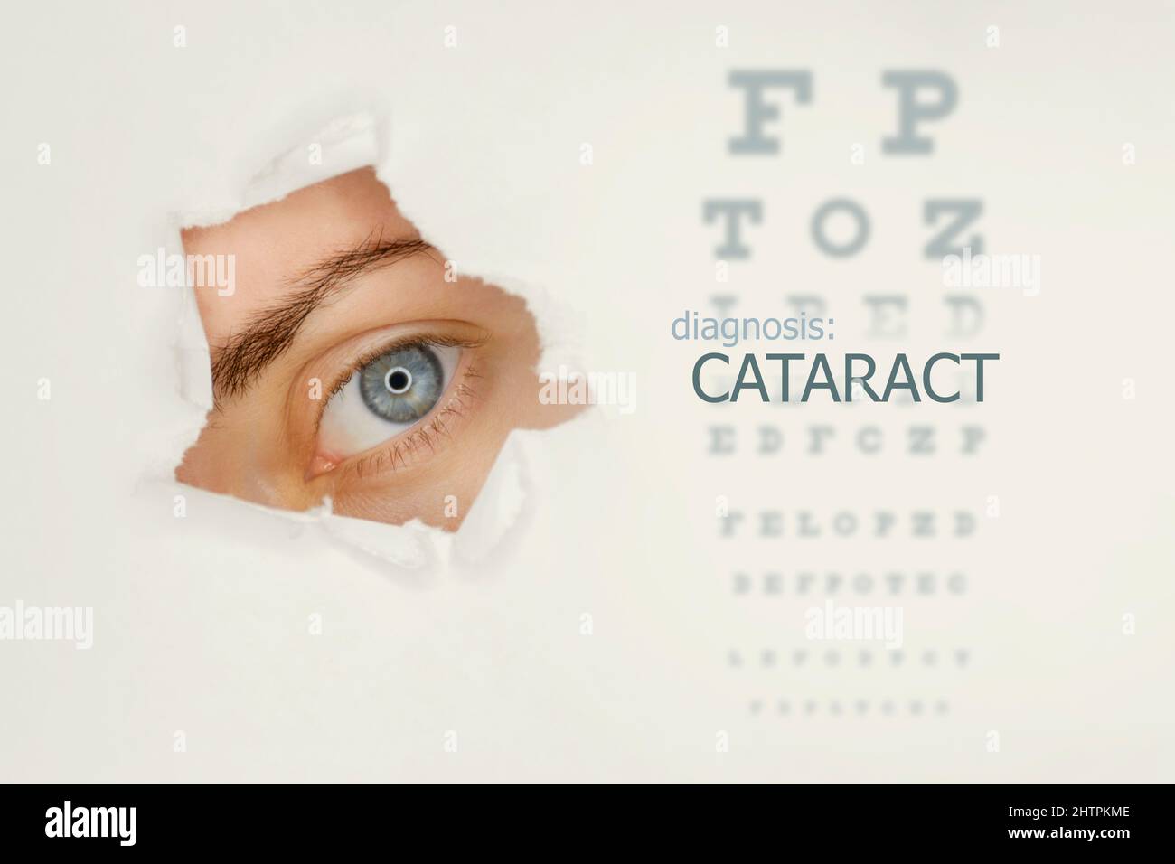 Cataract disease poster wwith eye test chart and blue eye on left. Studio grey background Stock Photo
