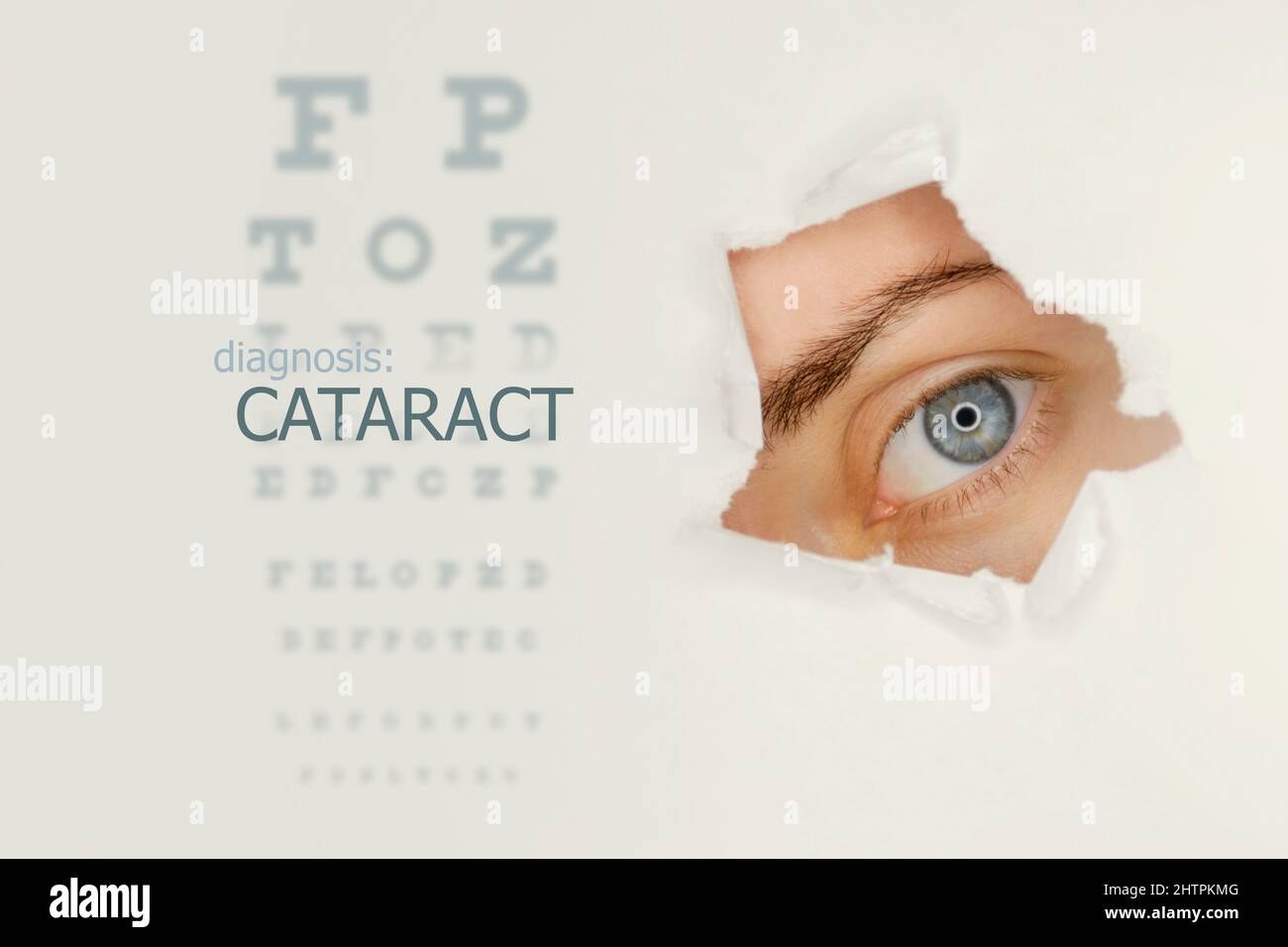 Cataract disease poster wwith eye test chart and blue eye on right. Studio grey background Stock Photo