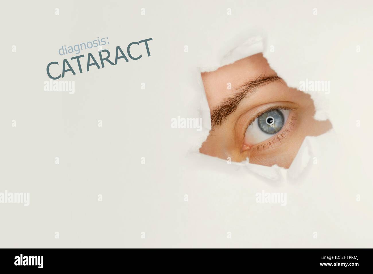 Cataract disease poster with blue eye on right. Studio grey background Stock Photo