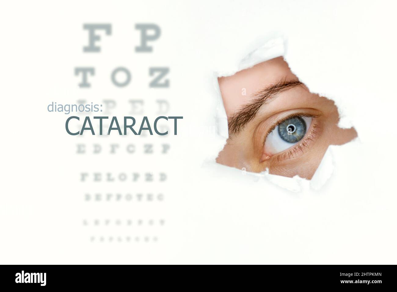 Cataract disease poster with eye test chart and  blue eye on right.Isolated on white Stock Photo