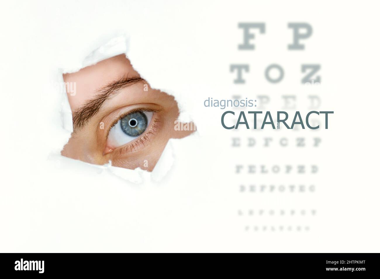Cataract disease poster with eye test chart and  blue eye on left.Isolated on white Stock Photo
