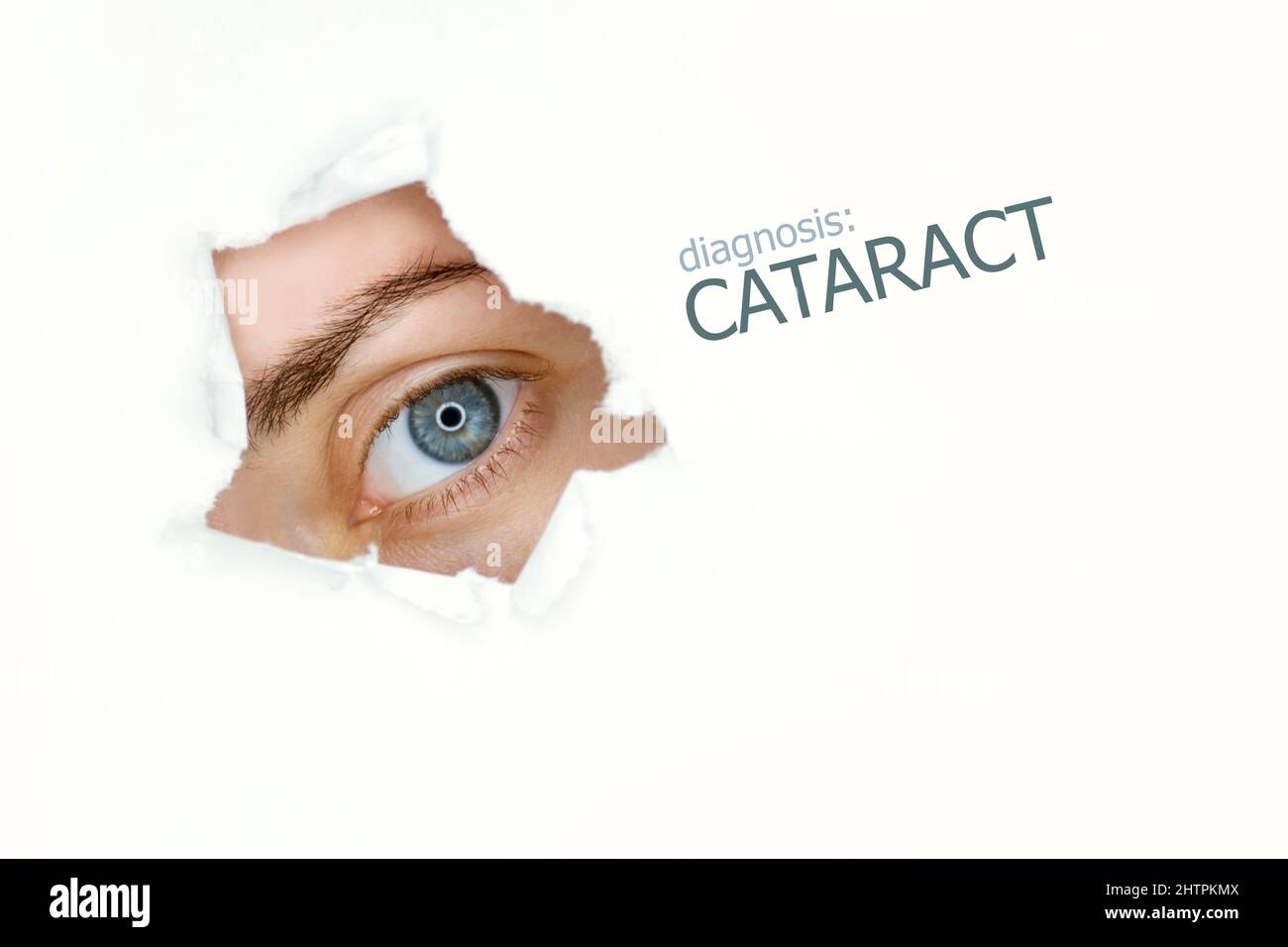 Cataract disease poster with  blue eye on left.Isolated on white Stock Photo