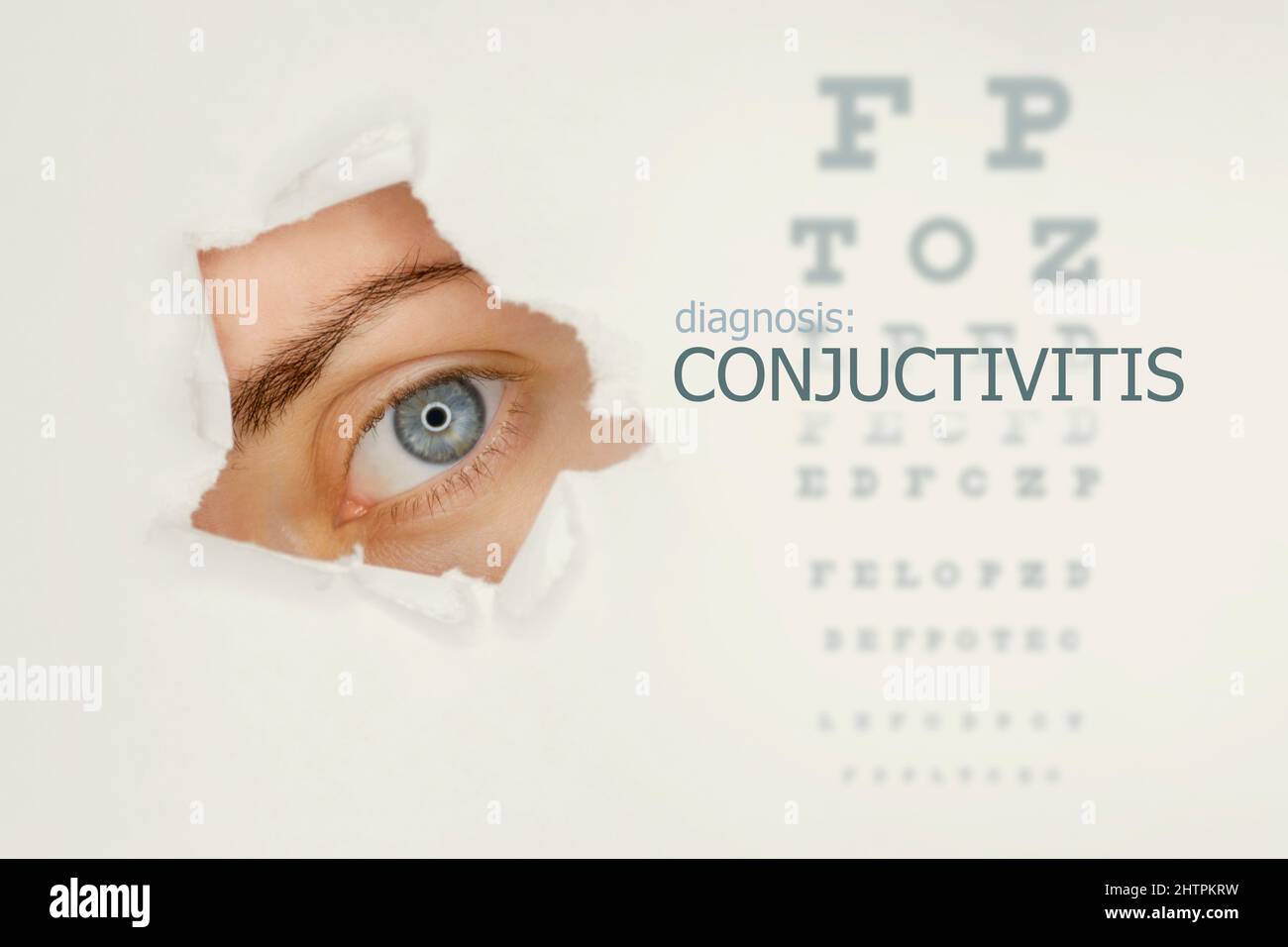 Conjuctivitis disease poster with eye test chart and blue eye on right. Studio grey background Stock Photo