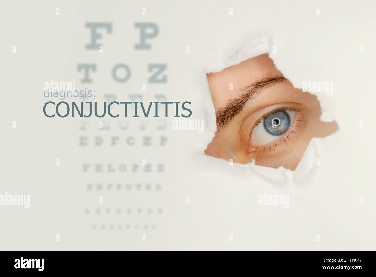 Conjuctivitis disease poster with eye test chart and blue eye on right. Studio grey background Stock Photo