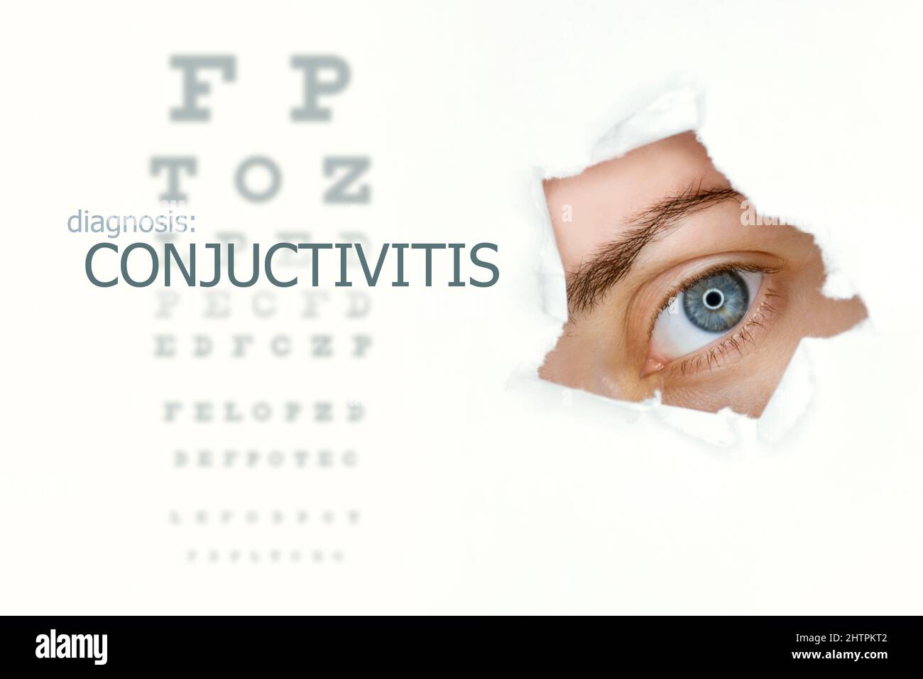 Conjuctivitis disease poster with eye test chart and blue eye. Isolated on white Stock Photo