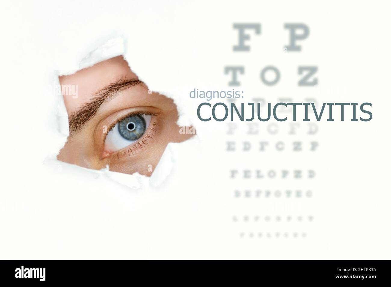 Conjuctivitis disease poster with eye test chart and blue eye. Isolated on white Stock Photo
