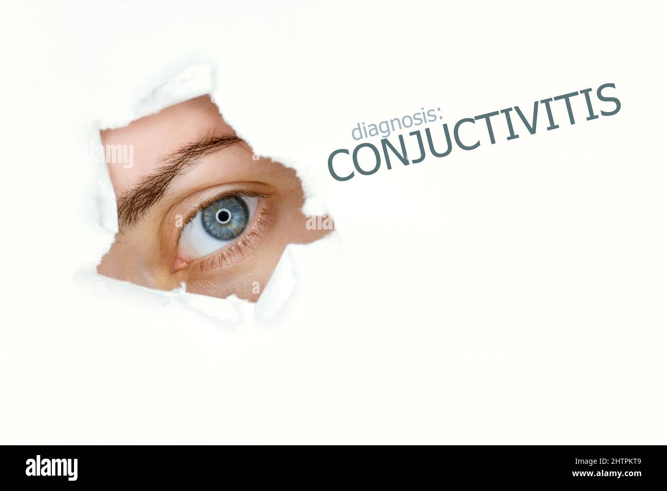 Conjuctivitis disease poster with blue eye on left.Isolated on white Stock Photo