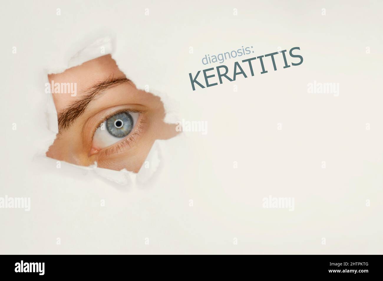 Keratitis disease poster with eye test chart and blue eye. Studio grey background Stock Photo