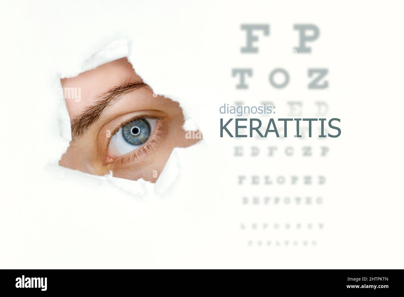 Keratitis disease poster with eye test chart and blue eye.  Isolated on white Stock Photo
