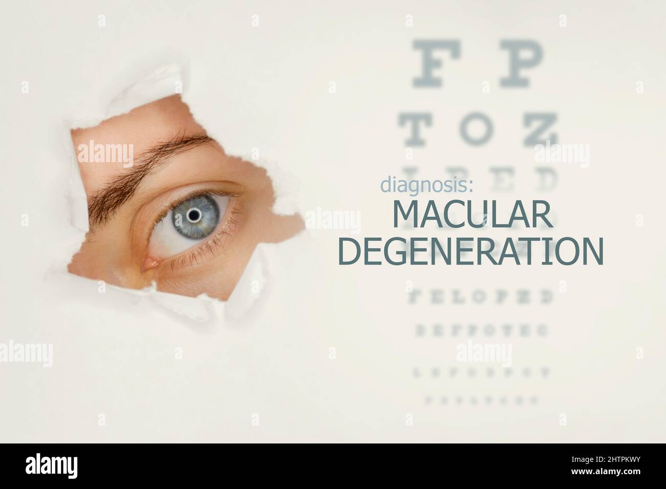 Macular degeneration disease poster with eye test chart and blue eye. Studio grey background Stock Photo