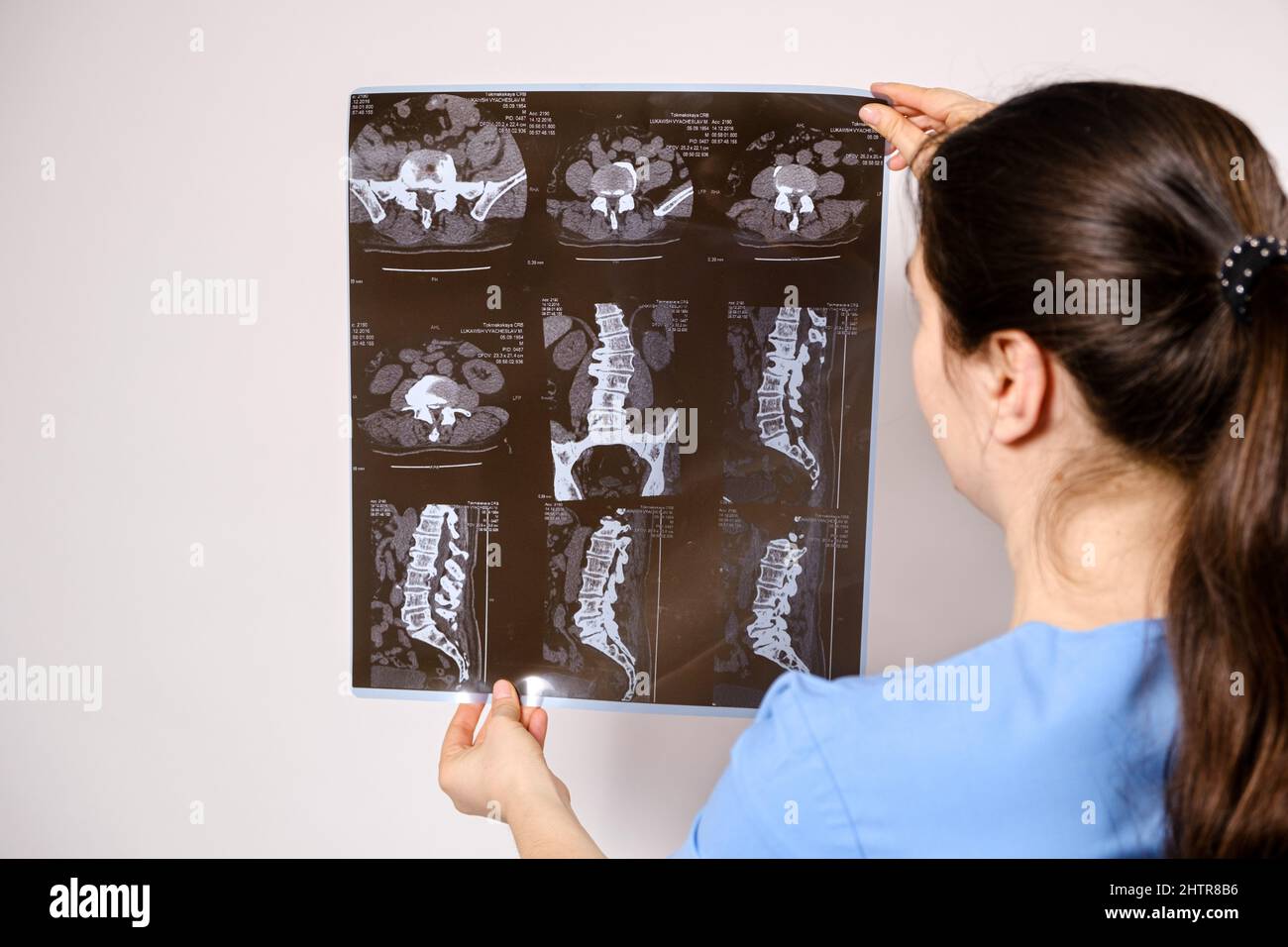 The doctor holds a CT scan of the spine of a patient with scoliosis and protrusion of the intervertebral discs Stock Photo