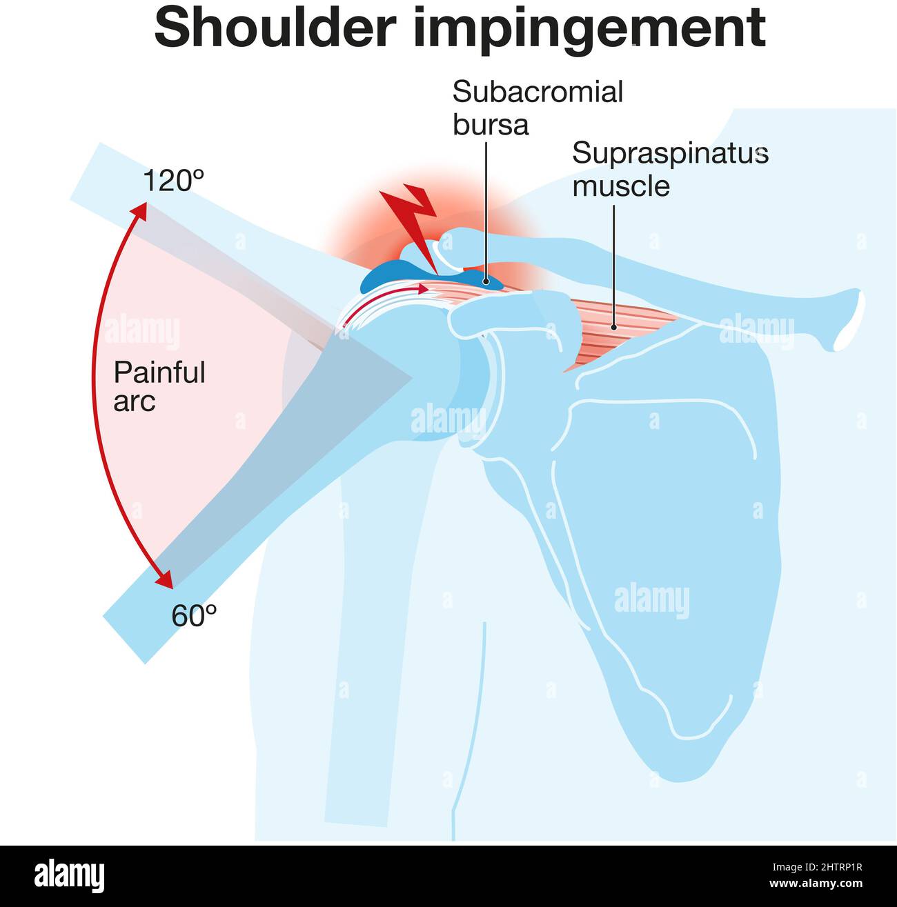 Illustration showing shoulder impingement Stock Photo