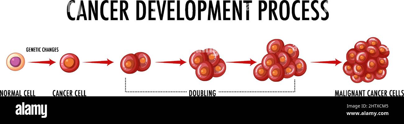 Cancer development process infographic illustration Stock Vector Image ...