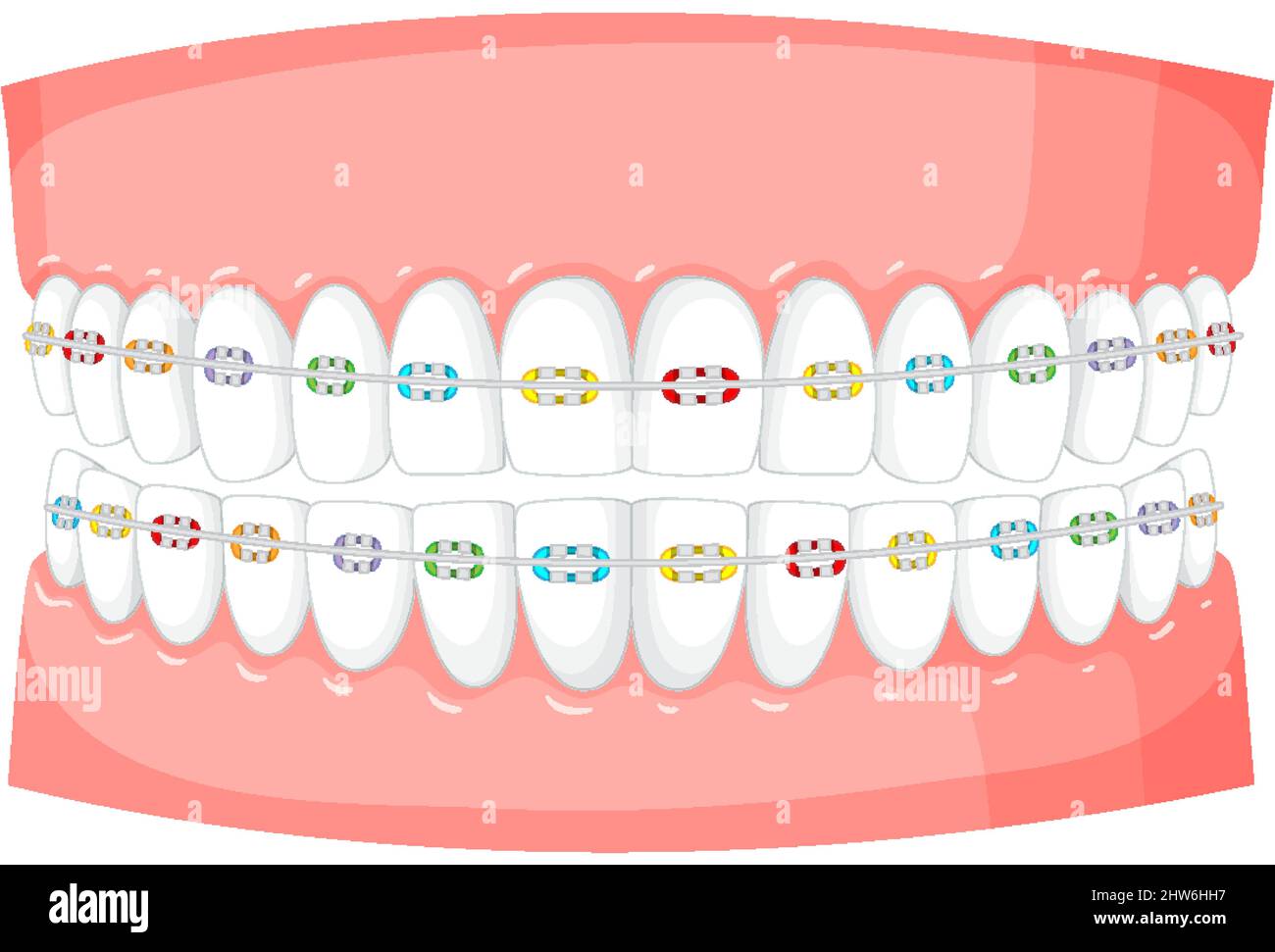 Braces on a model of human teeth on white background illustration Stock ...