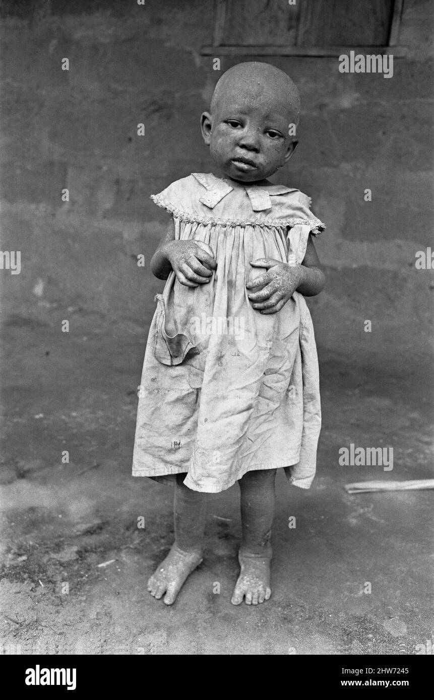 A young girl burnt in a Nigerian bombing raid and staving at the Queen Elizabeth Hospital, Umuahia just one of the estimated one to two million victims of the Biafran War. 23rd June 1968The Nigerian Civil War, also known as the Biafran War endured for two and a half years, from  6 July 1967 to 15 January 1970, and was fought to counter the secession of Biafra from Nigeria. The indigenous Igbo people of Biafra felt they could no longer co-exist with the Northern-dominated federal government following independence from Great Britain. Political, economic, ethnic, cultural and religious tensions f Stock Photo