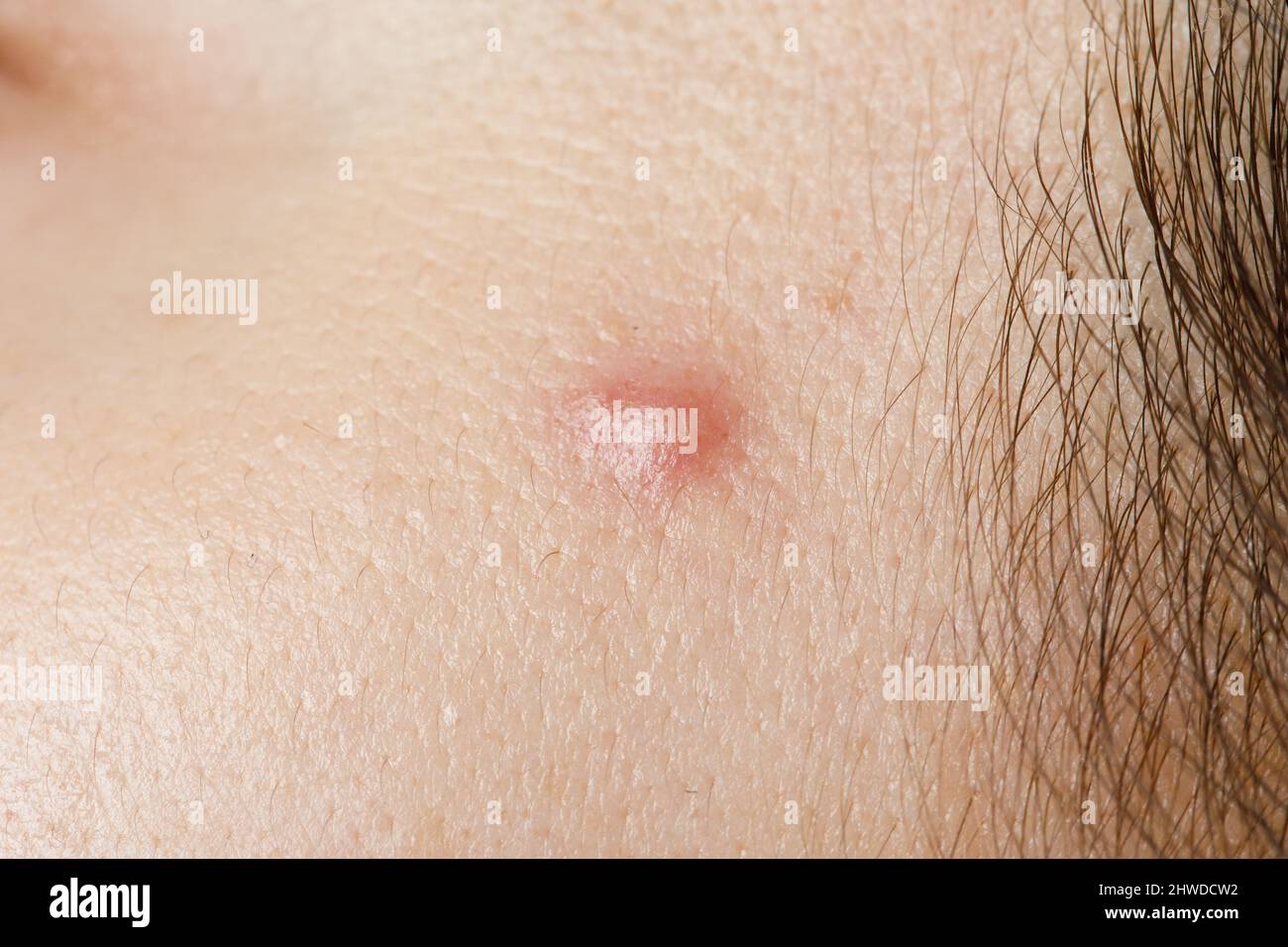 Macro Photo Of A Pimple Stock Photo Alamy