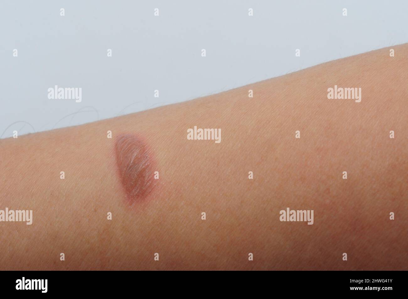 Blister was caused by a burn or scald, sunburn, or an allergic reaction, Blisters often heal on their own within a week Stock Photo