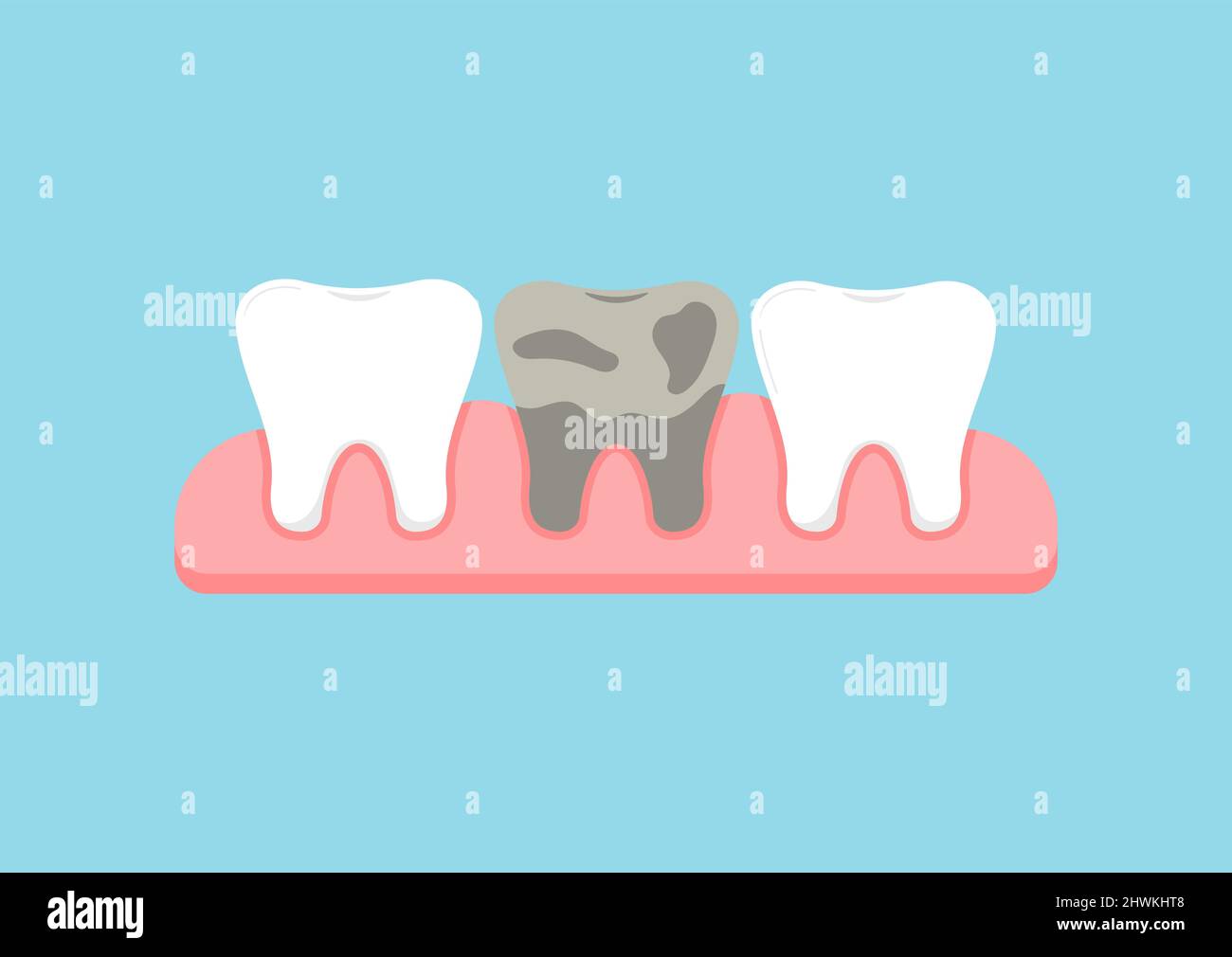Teeth in gum with dead decay tooth dentistry sign isolated on blue ...