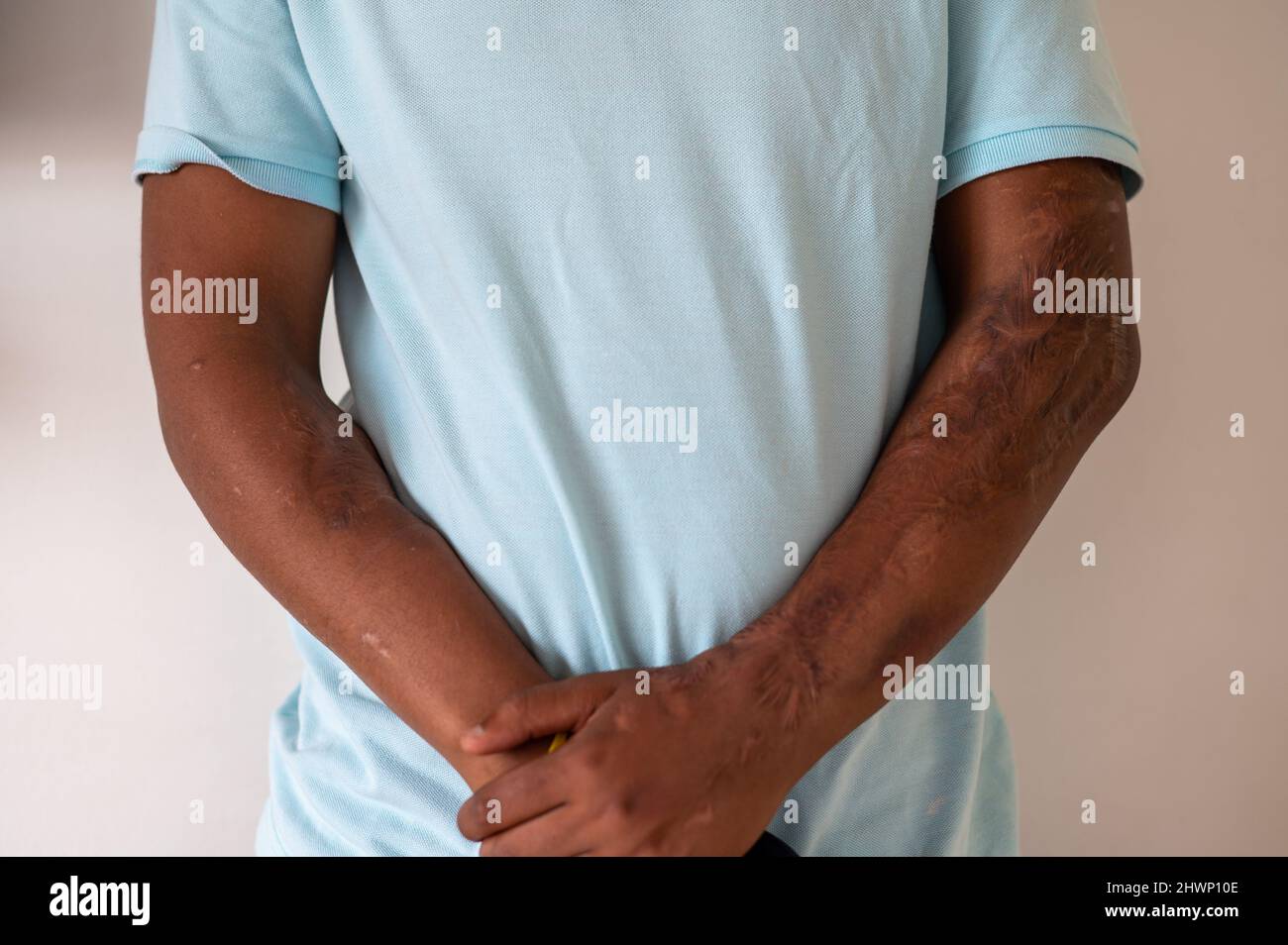 Close up shot of person with wounds Stock Photo