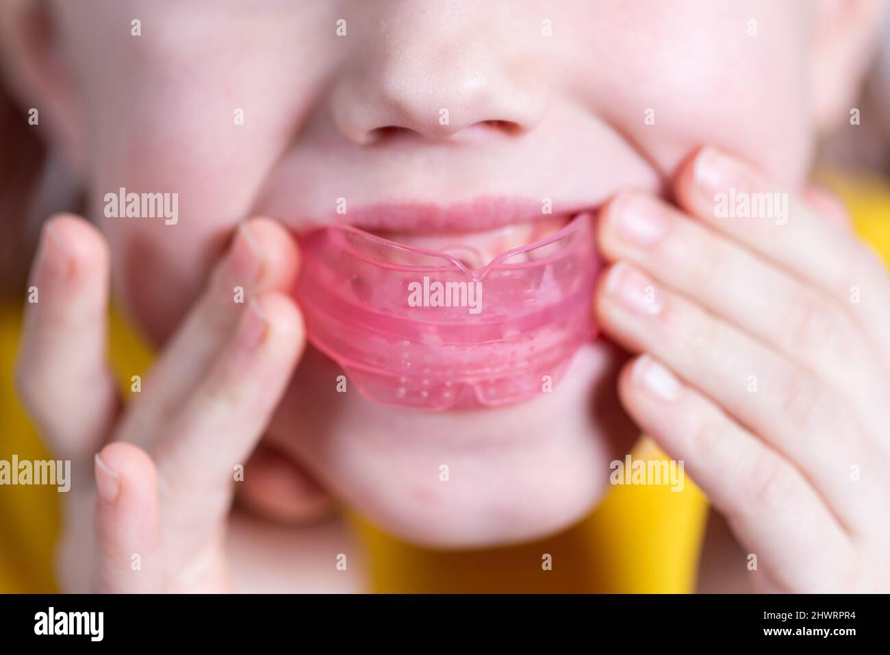 Six-year old caucasian girl shows myofunctional trainer. dental tariner is made to help equalize growing teeth and correct bite, develop mouth breathi Stock Photo