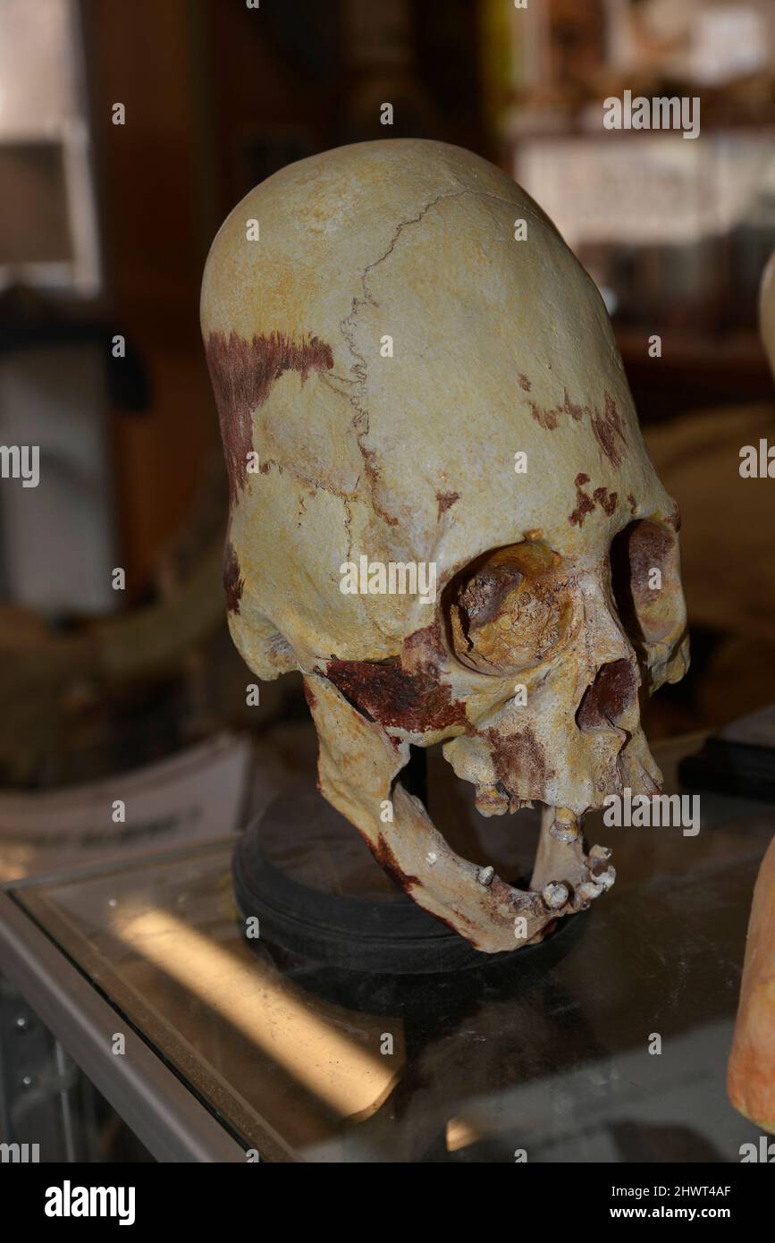 Intentional skull deformation was performed in ancient cultures around the world.  It was done on infants for  social reasons by the ancient cultures. Stock Photo