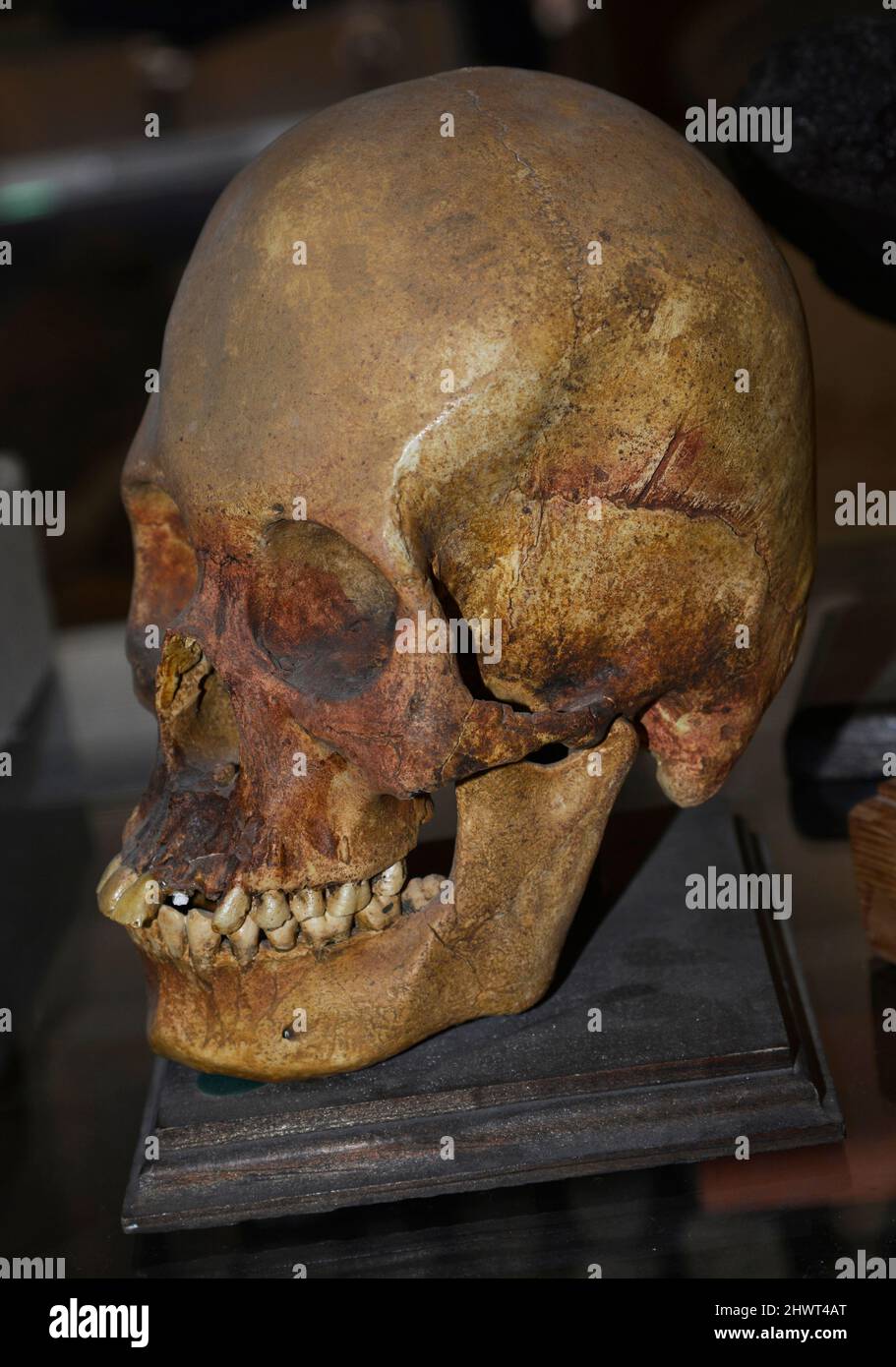 Intentional skull deformation was performed in ancient cultures around the world.  It was done on infants for  social reasons by the ancient cultures. Stock Photo
