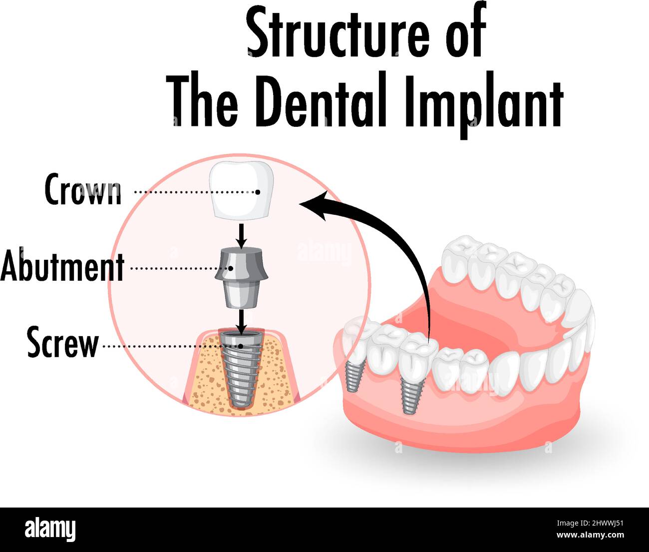 Infographic of human in structure of the dental implant illustration