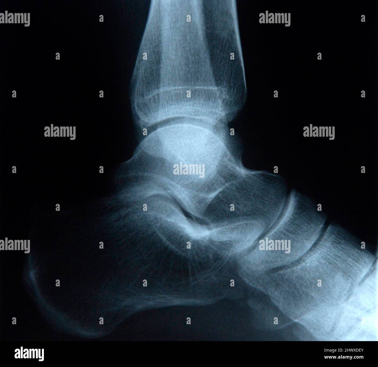 Foot bones x rays hires stock photography and images Alamy