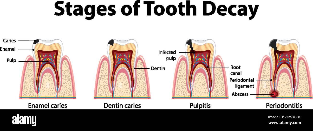 Infographic of human in the stages of tooth decay illustration Stock Vector