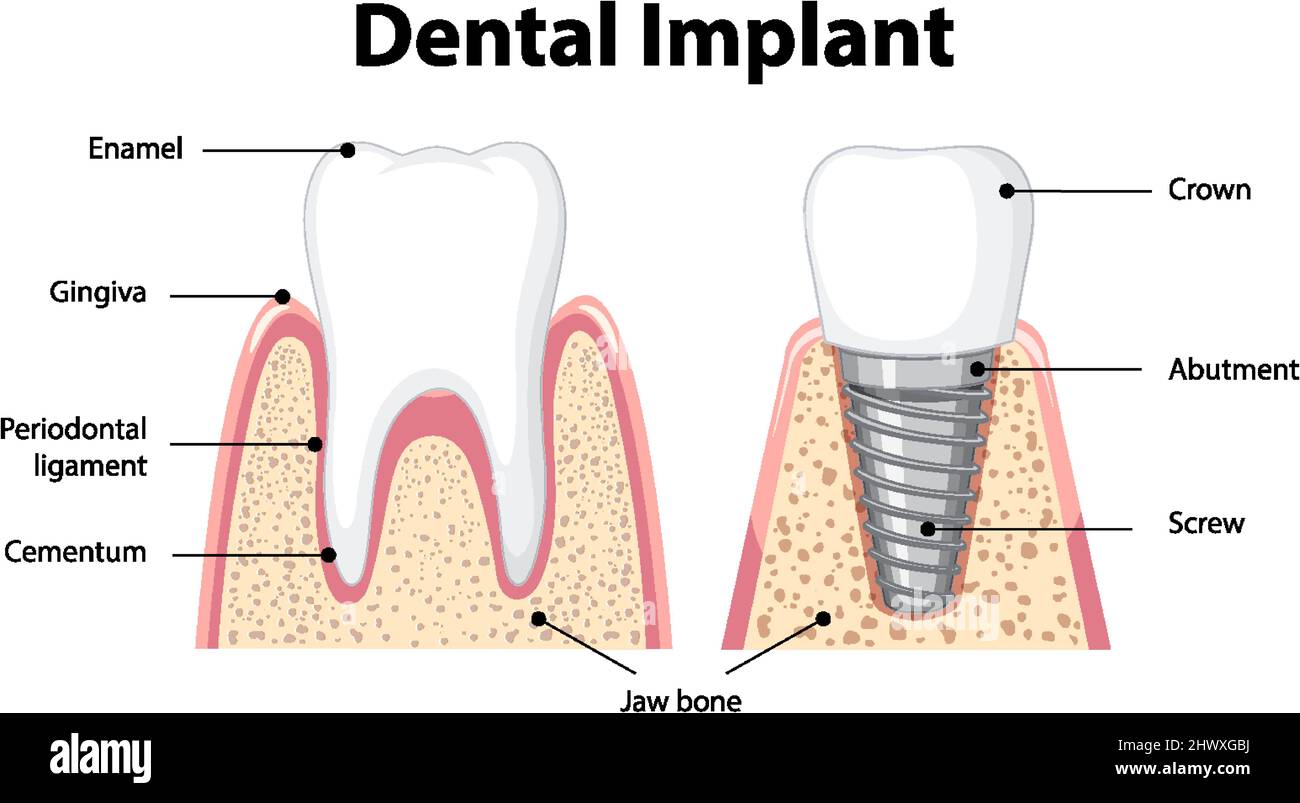 Infographic of human in structure of the dental implant illustration