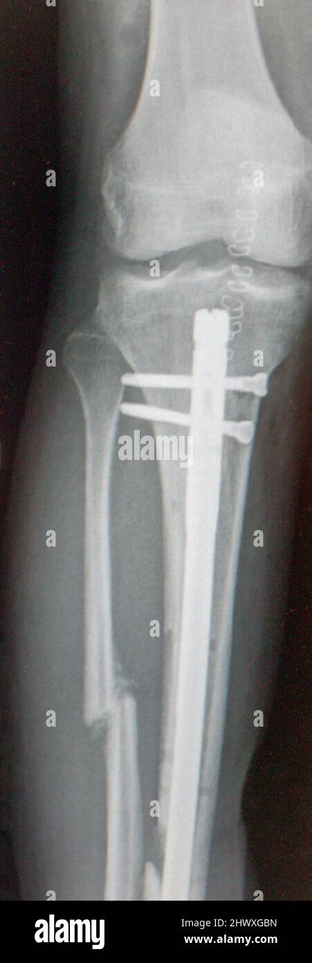 X-ray of right leg with support pins following a broken fibula. Stock Photo