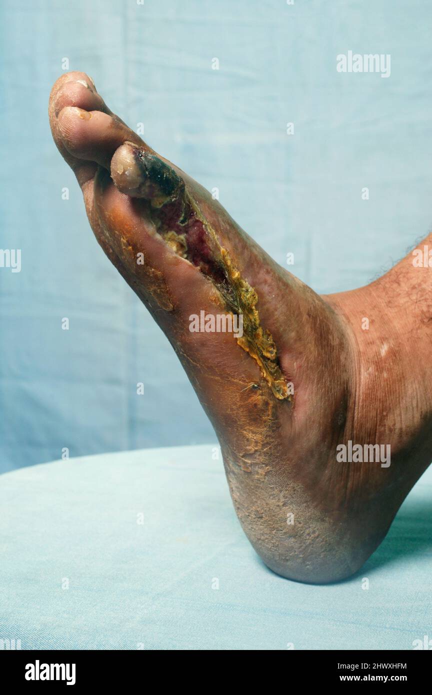 Close up of a left foot with Buerger's disease - inflammation of the blood vessels of the extremties, producing clotting within them. Accordingly, the Stock Photo