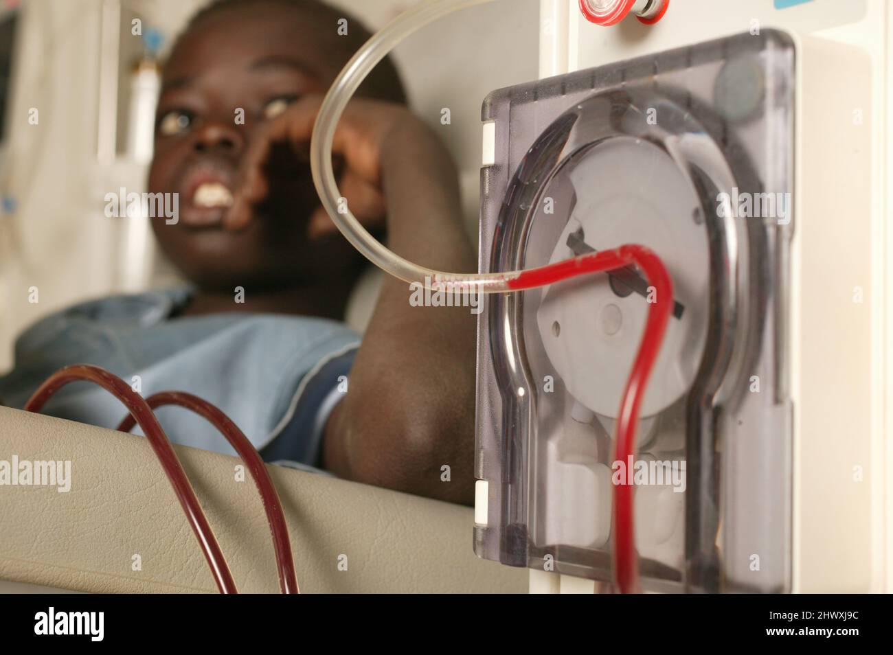 A young boy attached to a dialysis machine. The kidney dialysis machine