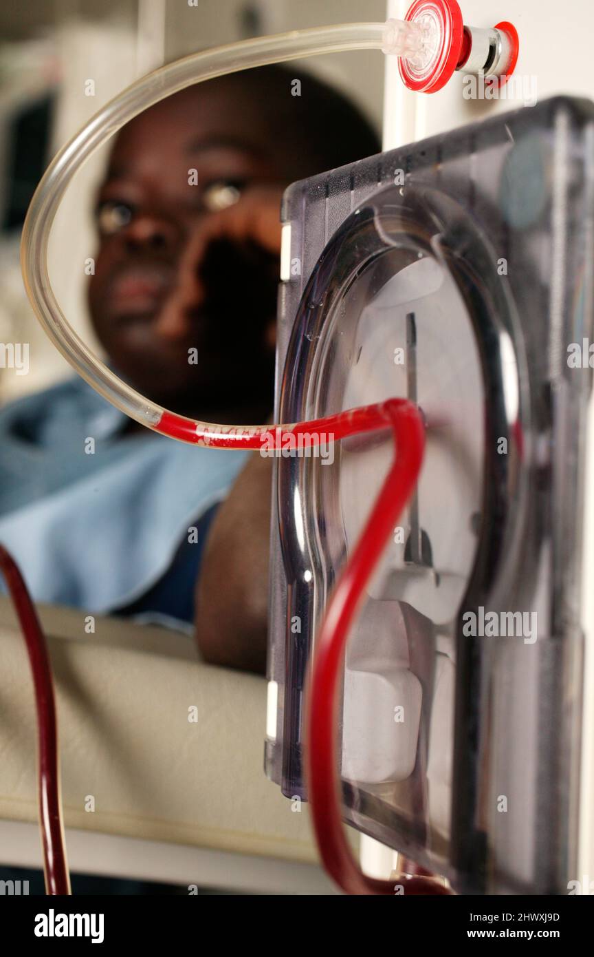 A young boy attached to a dialysis machine. The kidney dialysis machine