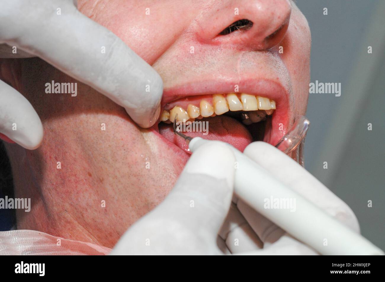 A dentist uses a dental scraper along with a dental mirror to remove
