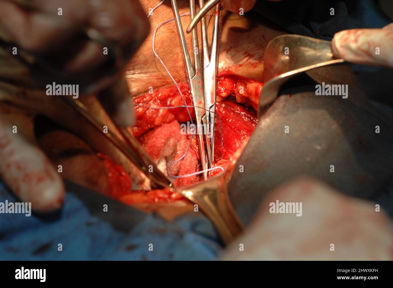 Uterine fibroid surgery. Uterine fibroids are benign (noncancerous