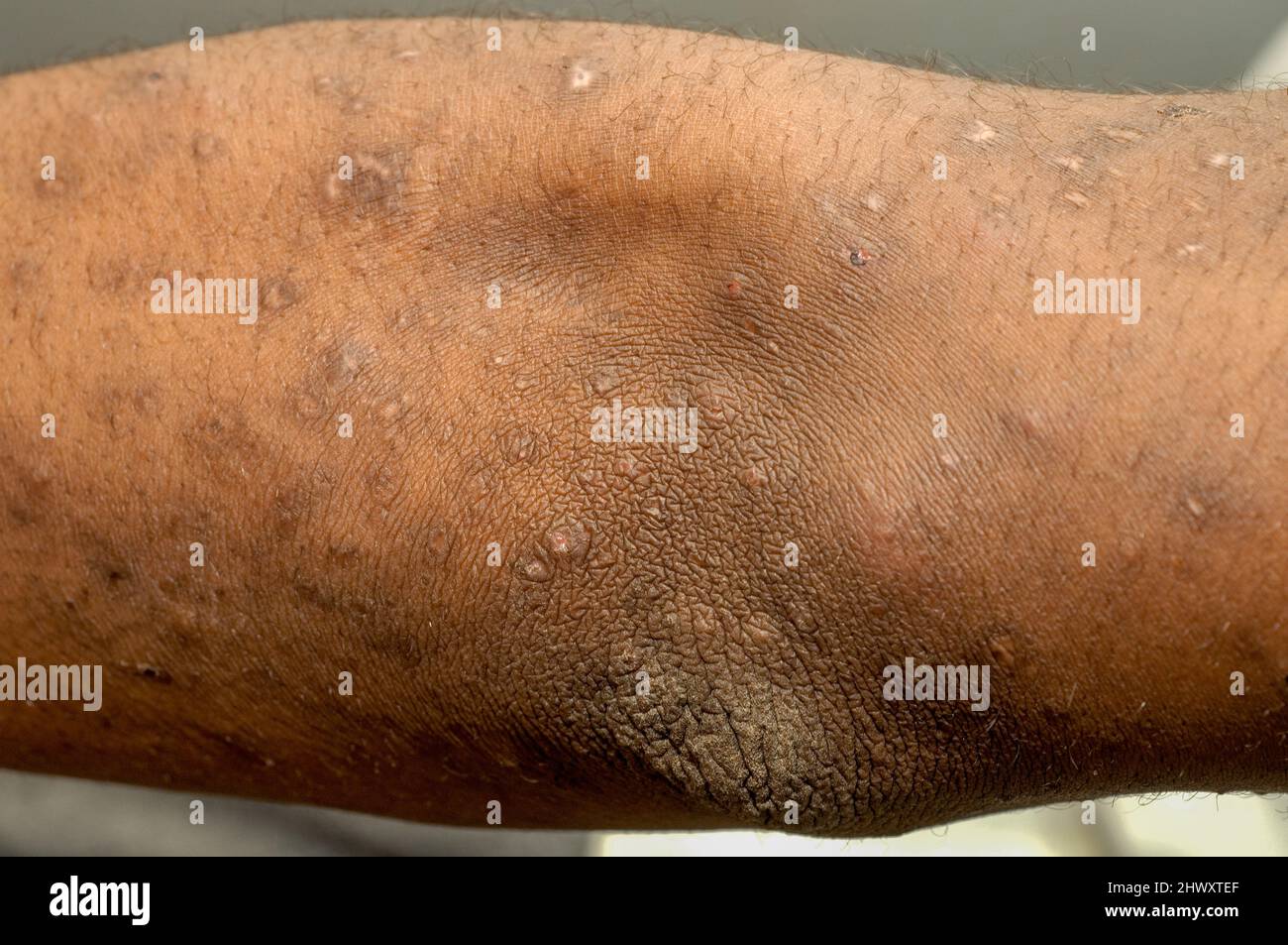 The arm of a patient with mild psoriasis Psoriasis is a common, chronic  relapsing/remitting immune-mediated skin disease characterized by red,  scaly p Stock Photo - Alamy