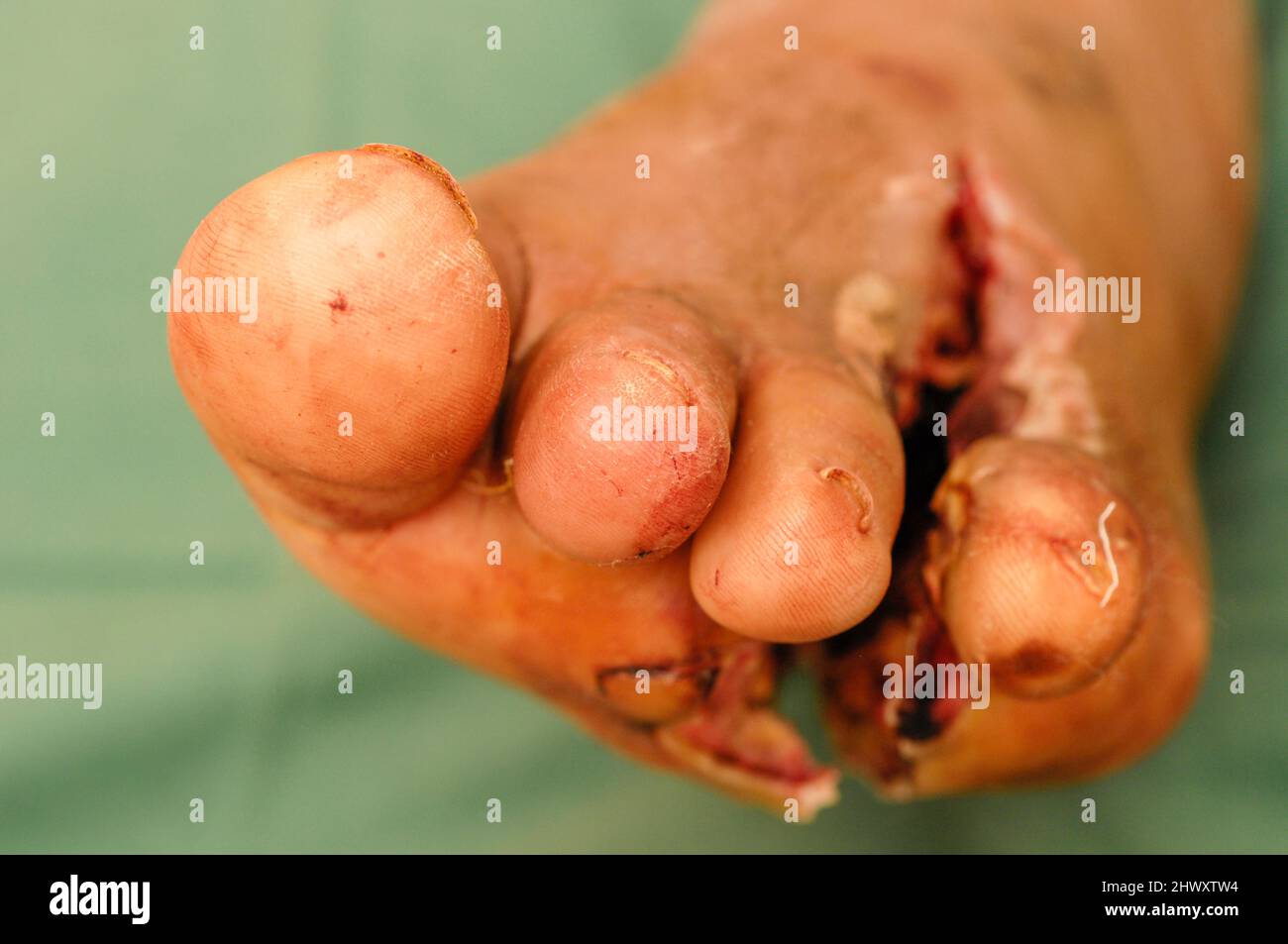 The left foot of a patient who has had to endure amputation of their fourth toe in order to save the rest of her foot from an infection. An example of Stock Photo