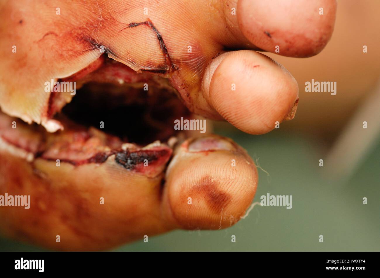 A patient with diabetes suffering with a septic foot. Unregulated hyperglycaemia (high blood glucose levels) leads to non-enzymic glycation of protein Stock Photo