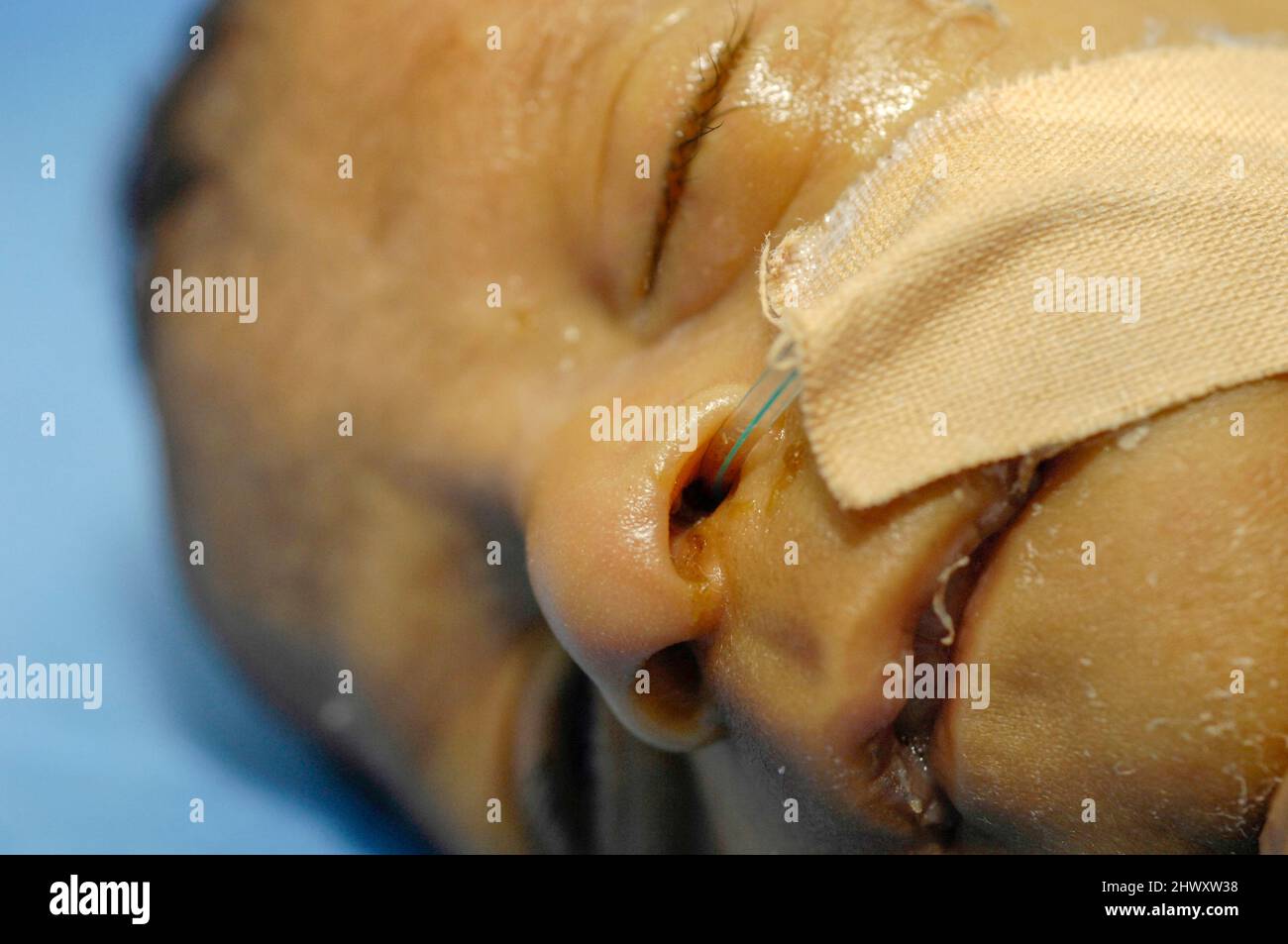A close-up of a premature baby in an incubator in the neonatal unit of a hospital. Premature babies are placed in incubator as they have not fully dev Stock Photo