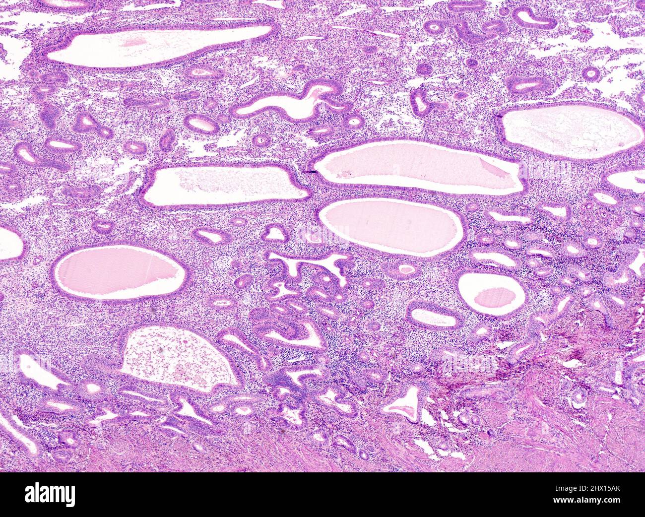 Nonatypical Endometrial Hyperplasia Light Micrograph Stock Photo Alamy nonatypical-endometrial-hyperplasia-light-micrograph-stock-photo-alamy