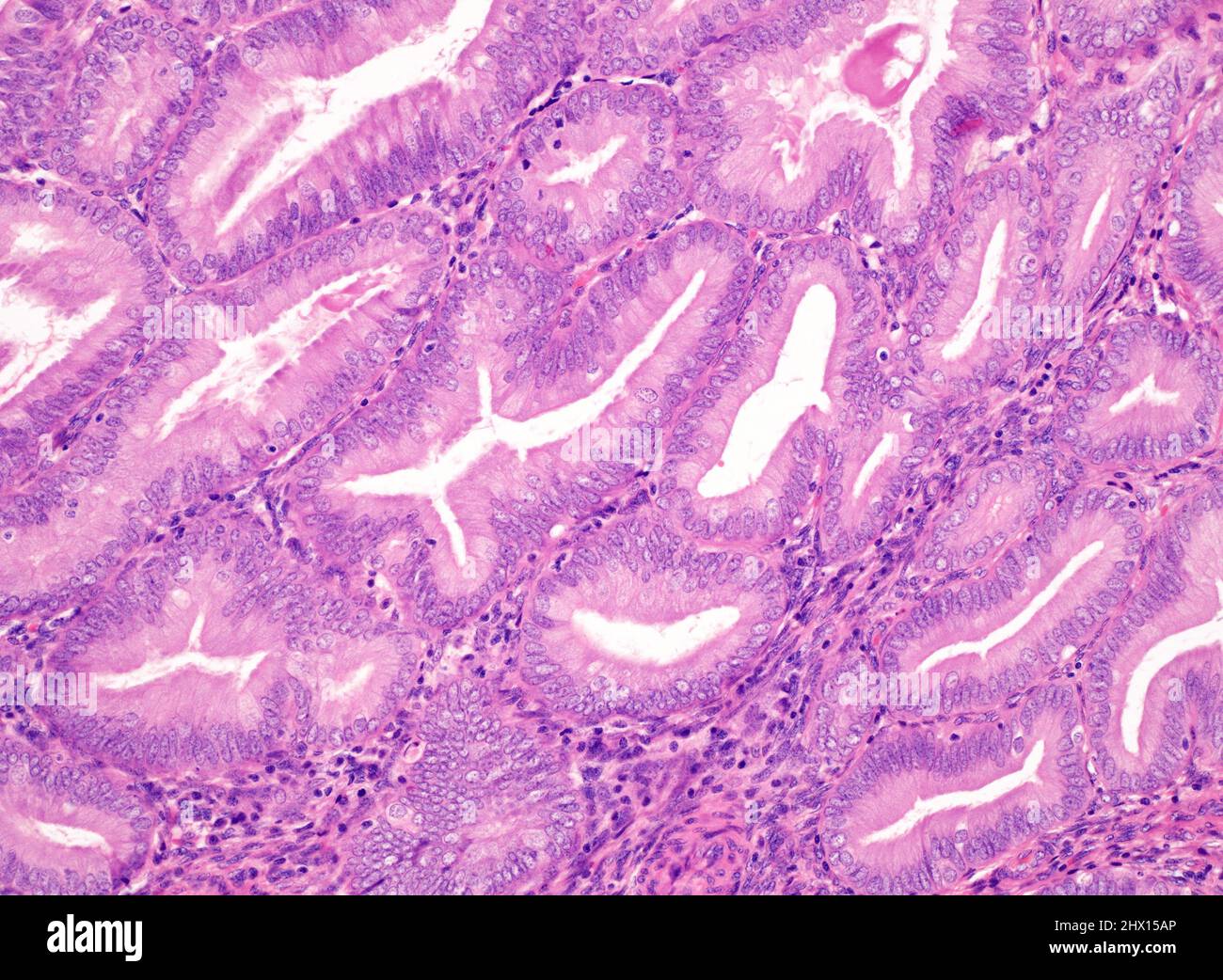 Nonatypical Endometrial Hyperplasia Light Micrograph Stock Photo Alamy nonatypical-endometrial-hyperplasia-light-micrograph-stock-photo-alamy