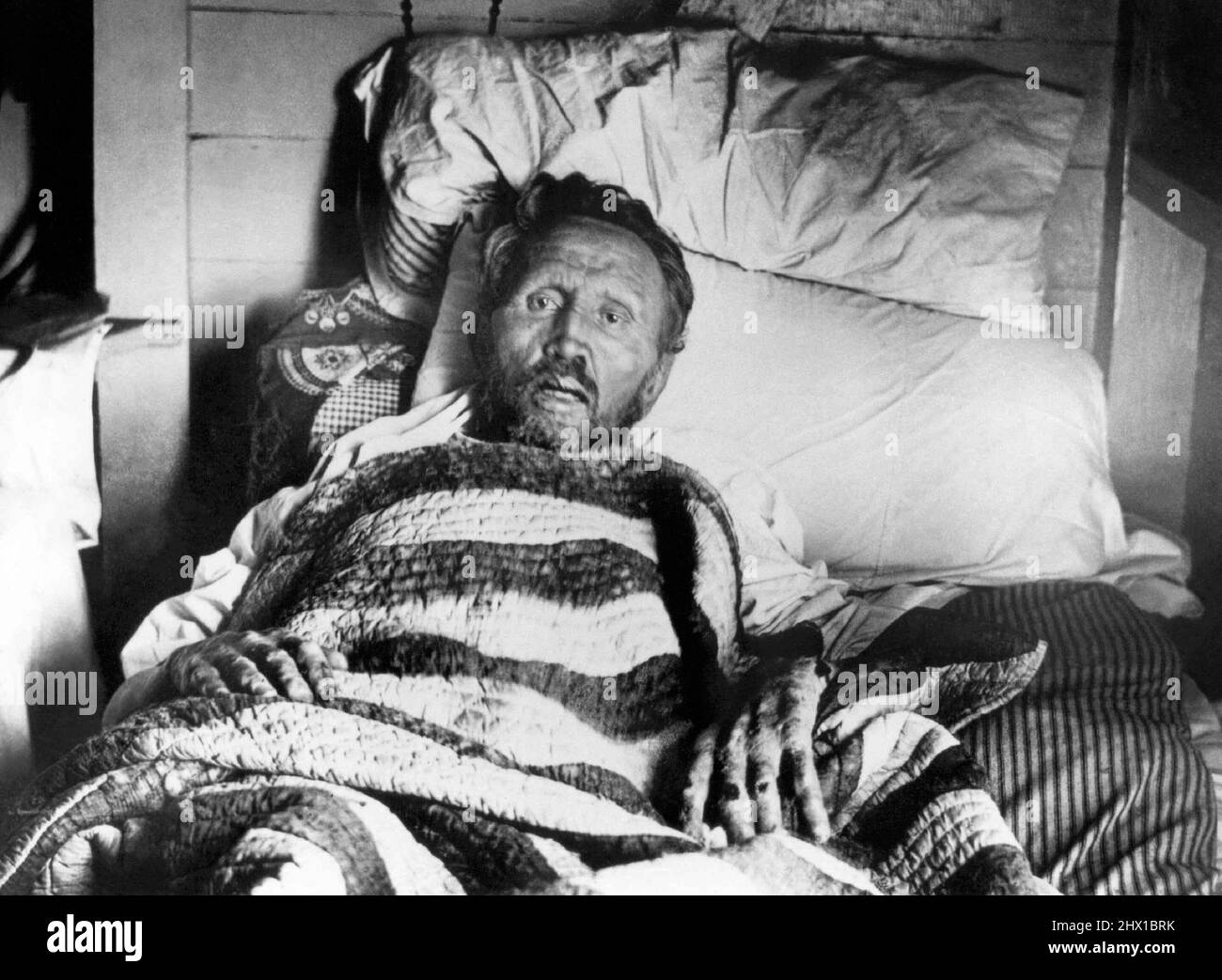 Father Damien (1840–1889), Roman Catholic missionary to lepers on the island of Molokai in the Sandwich (Hawaiian) Islands, on his deathbed after contracting leprosy from the people to whom he ministered. Photo presumably taken by Dr. Sydney B. Swift on Palm Sunday, April 14, 1889, the day before Damien died. Stock Photo
