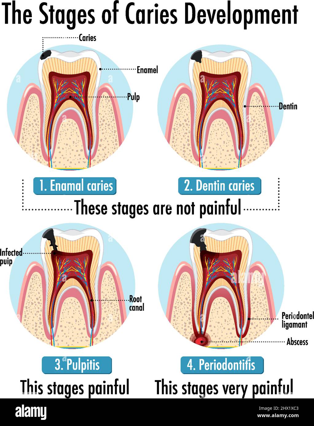 Infographic of human in the stages of caries development illustration Stock Vector