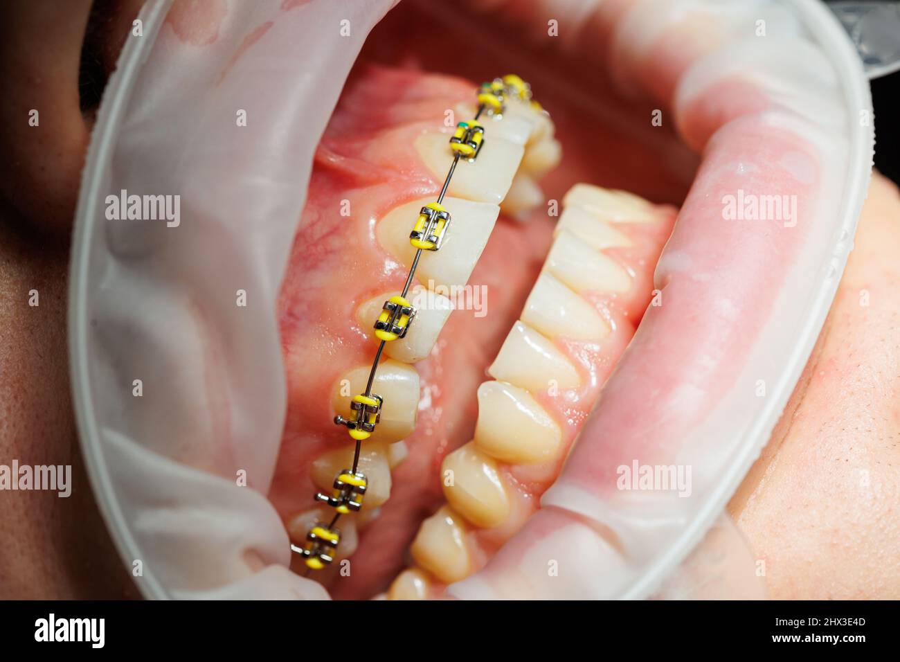 Extender for teeth. Teeth of a woman with braces at a dentist