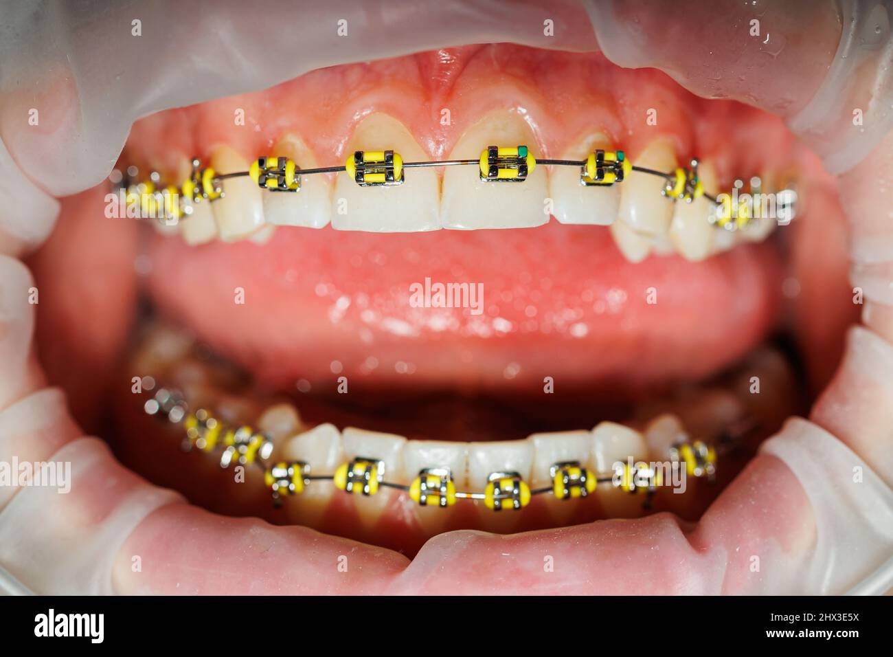 Extender for teeth. Teeth of a woman with braces at a dentist